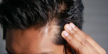 Hair Fall Treatment | Cosmoderma Patna