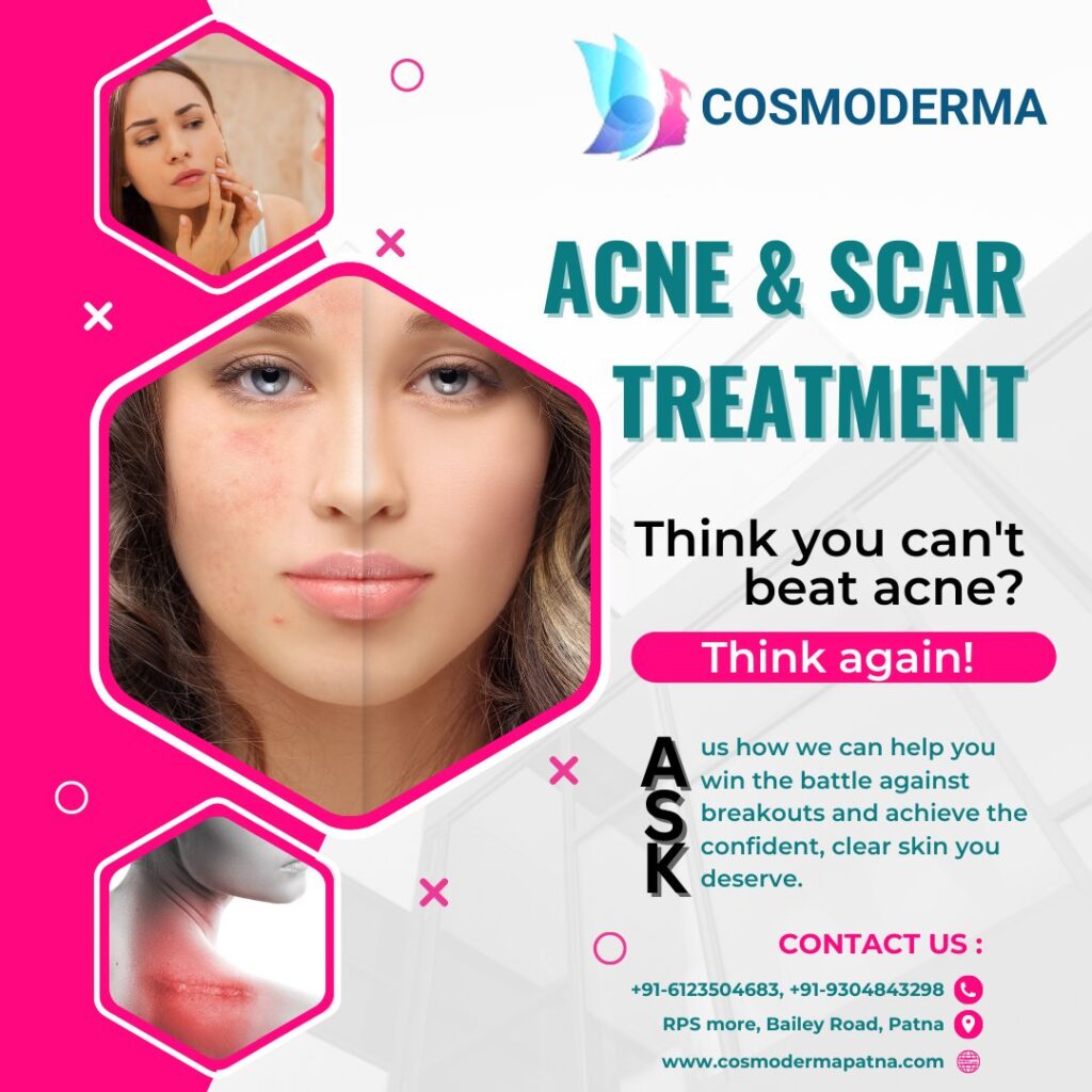 Acne and acne scar treatment - Cosmoderma patna