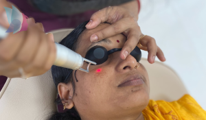 Hyper Pigmentation Treatment in Patna | Cosmoderma Patna